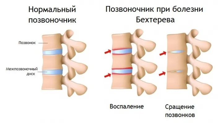 При болезнь Бехтерева позвонки сращиваются на фоне постоянного воспаления.