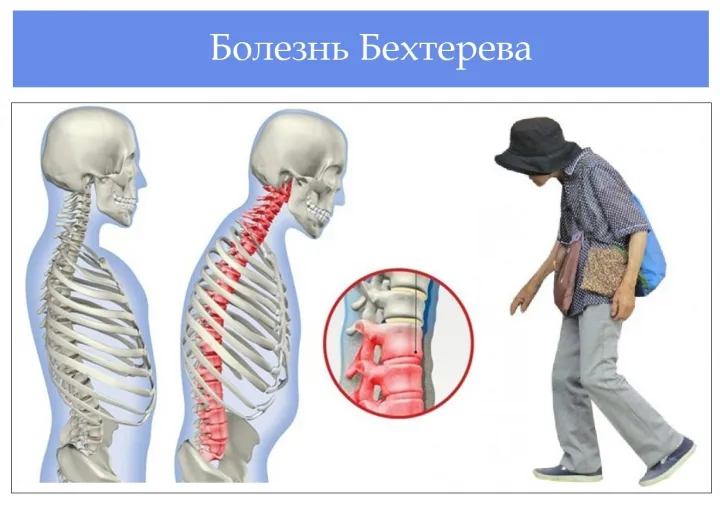 Отсутствие специфического препарата приводит многих больных к инвалидности.