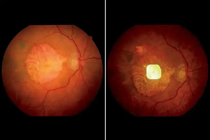 Глаз участника без ретинального имплантата (слева) и с имплантатом (справа). Глаз участника без ретинального имплантата (слева) и с имплантатом (справа).
