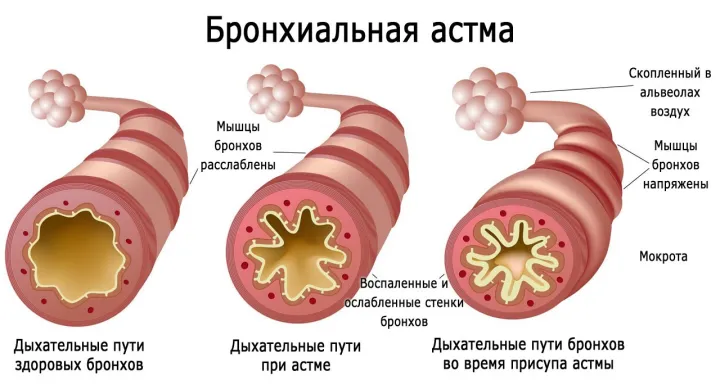 При астматическом приступе дыхательные пути воспаляются, что приводит к затруднению дыхания.