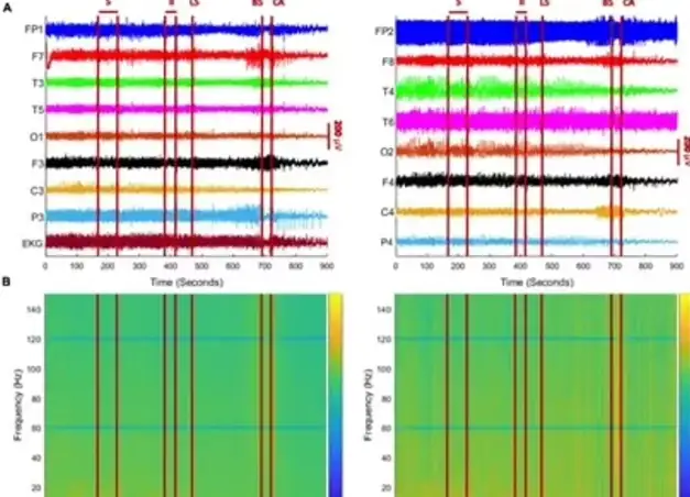 Нейробиологи зафиксировали 900 секунд мозговой активности в момент смерти. Нейробиологи зафиксировали 900 секунд мозговой активности в момент смерти.