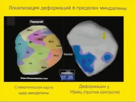 Изменения в структуре мозга под названием миндалевидное тело могут указывать на то, является ли человек хладнокровным убийцей. Изменения в структуре мозга под названием миндалевидное тело могут указывать на то, является ли человек хладнокровным убийцей.