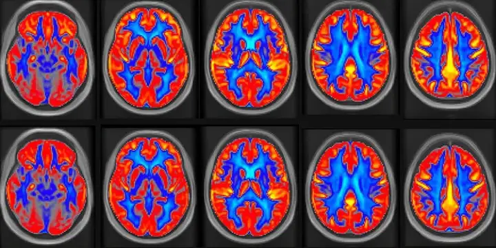 Состояние участников отслеживали при помощи МРТ. Состояние участников отслеживали при помощи МРТ.