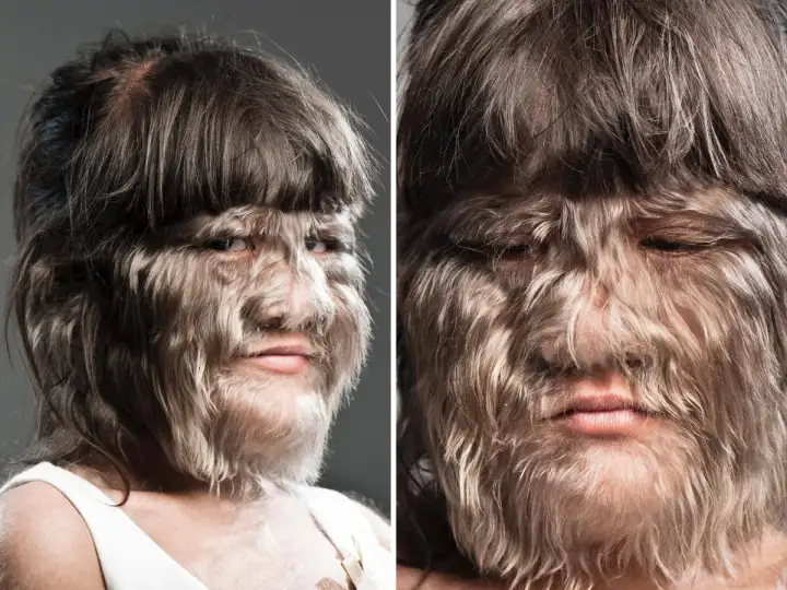 Супатра Саусупхан: как сложилась жизнь «самой волосатой девочки» спустя 15 лет.