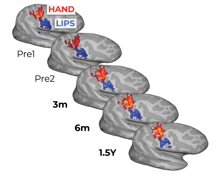 До и после ампутации в картах мозга наблюдалось очень мало изменений. До и после ампутации в картах мозга наблюдалось очень мало изменений.