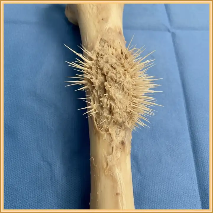 Остеосаркома. Остеосаркома.