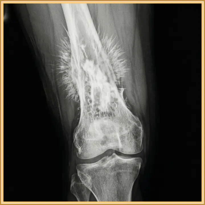 Остеосаркома на рентгене. Остеосаркома на рентгене.