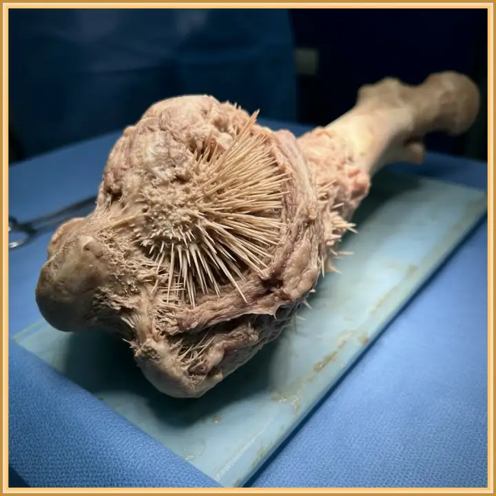 Остеосаркома - один из самых агрессивных форм рака. Остеосаркома - один из самых агрессивных форм рака.