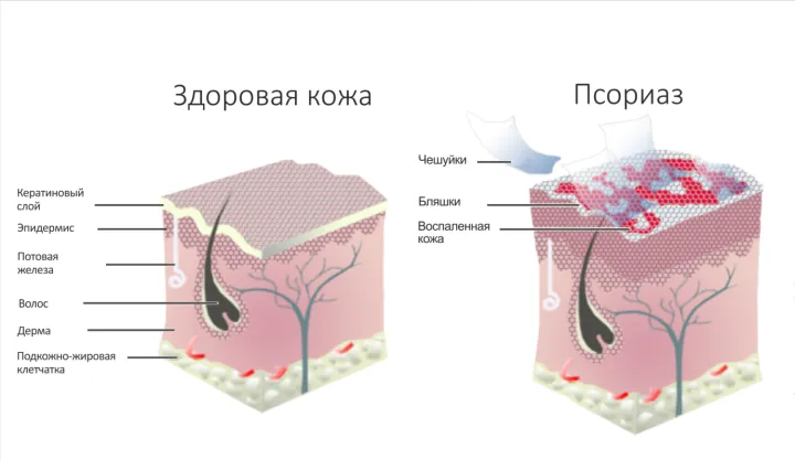 Псориаз превращает жизнь человека в ад.