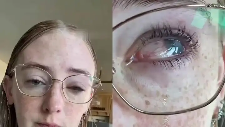 +1 фобия: девушка ослепла после того, как приняла душ в линзах