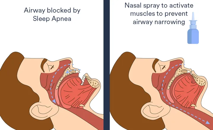 Назальный спрей удерживает верхние дыхательные пути открытыми.