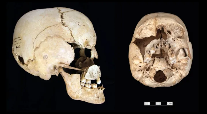 Найденный череп человека с синдромом Шерешевского — Тёрнера.