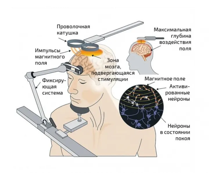 Транскраниальная магнитная стимуляция является новейшим методом воздействия на головной мозг, однако у неё есть свои противопоказания.