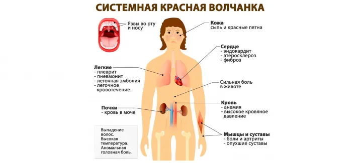 Волчанка - серьёзное аутоиммунное заболевание, при котором организм фактически атакует сам себя.