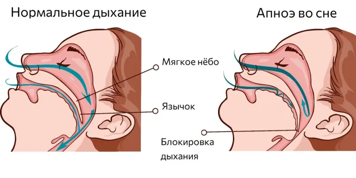 Механизм возникновения апноэ во сне.