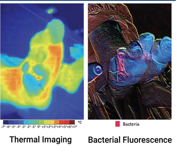 Устройство выявляет воспаление по показателям тепла и флуоресценции бактерий.